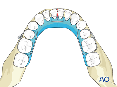 Occlusal splints for Symphysis and parasymphysis - simple