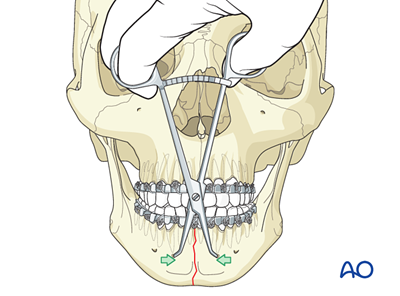 ORIF, strut plate (strut/box/ladder plate) for Symphysis and ...