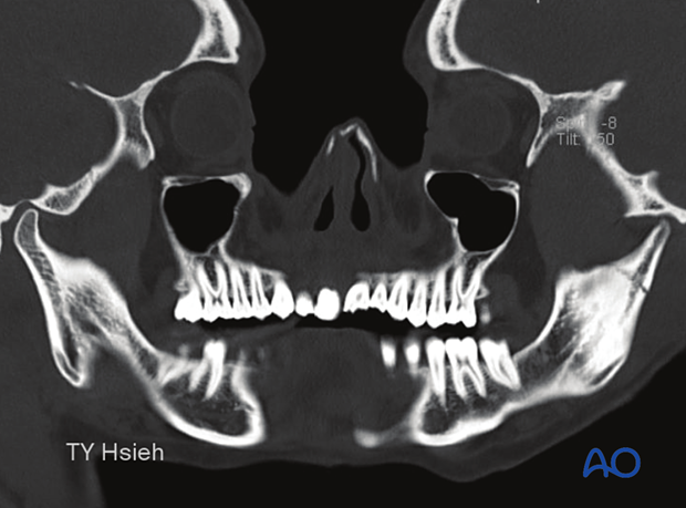 This patient sustained a symphyseal and subcondylar fracture.