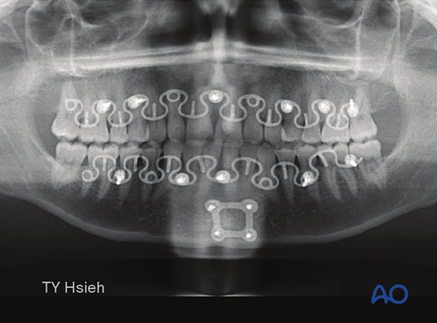 The symphyseal fracture was treated with a 3D box plate.