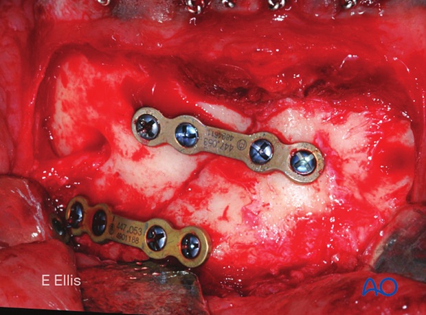 This clinical picture shows fracture fixation with two mandibular miniplates 2.0.