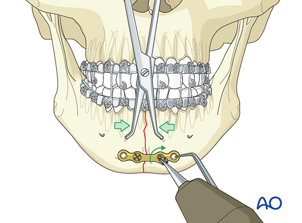 Insertion of second screw