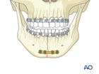 Symphysis and parasymphysis simple