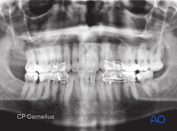 There is a midbody fracture line at the level between the second premolar and the first molar. 