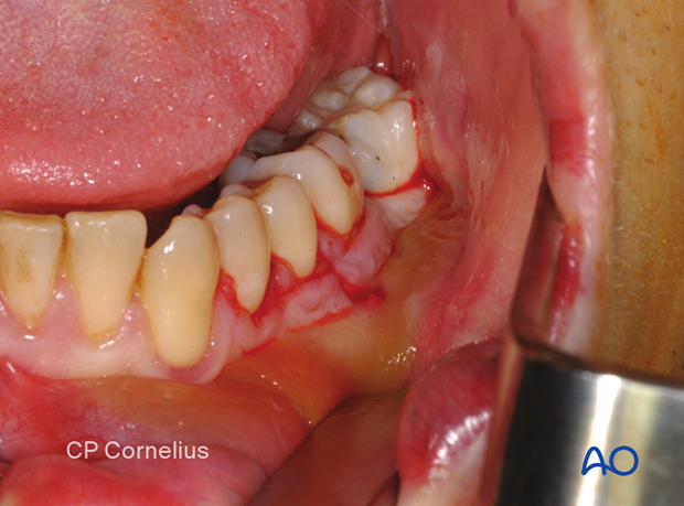 since there is an laceration between the second premolar and the first molar, an alternative surgical approach is used. 