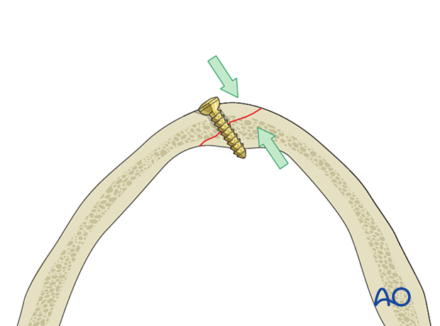 Lag scrwe insertion in oblique fracture