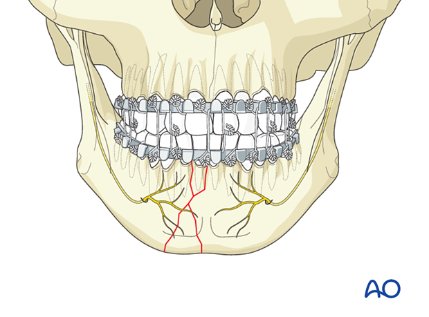 Arch bars applied to mandible and maxilla