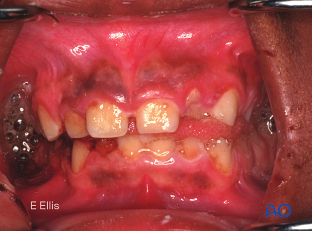 Clinical image of malocclusion