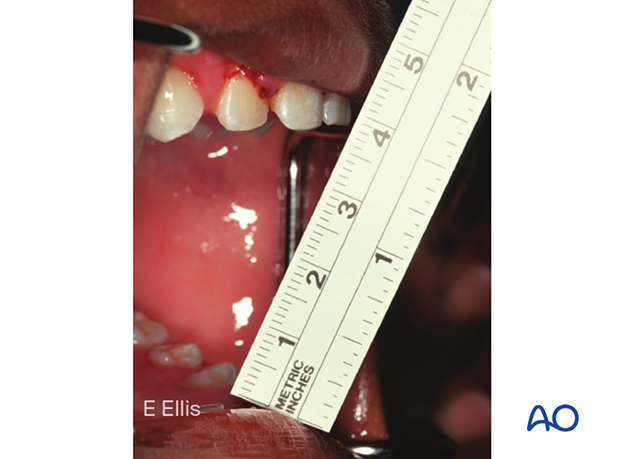 Measurement of interincisal distal