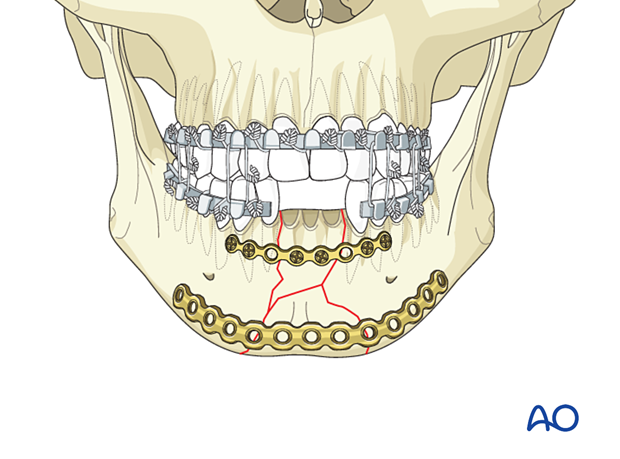 Contoured plate applied to the inferior mandible