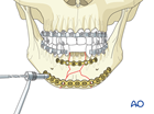 symphysis and parasymphysis complex