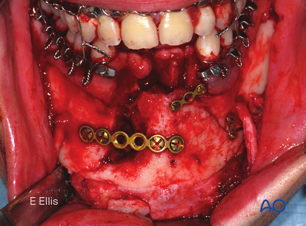 Clinical image of simplified fracture