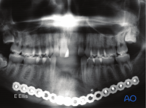 X-ray shows the completed osteosynthesis 12 weeks postoperatively.