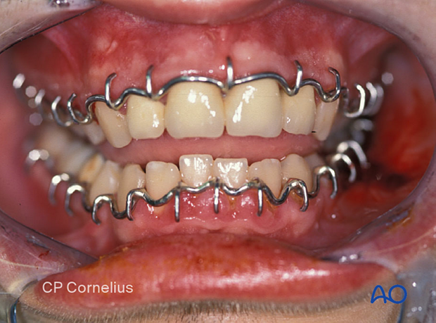 The clinical image shows the preshaped arch bar before applying MMF.