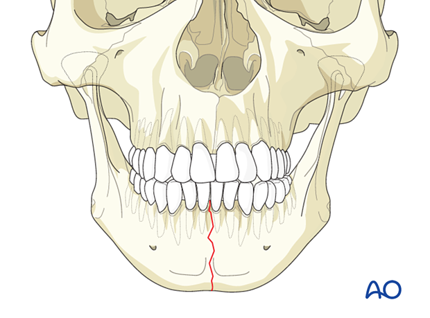 Symphysis and parasymphysis simple