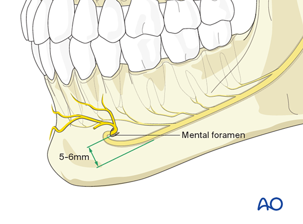 Bicortical screws should be inserted more than 5-6 mm caudal to the mental foramen because of the inferior alveolar nerve path in this area