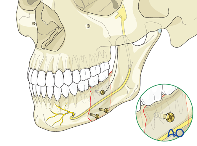 ORIF, lag screws for Body - simple