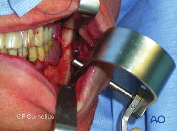 Use of the transbuccal system