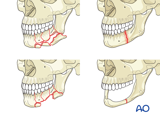 comminuted , cronically infected simple fractures, segmental defects, and fractures of the edentulous atrophic mandible