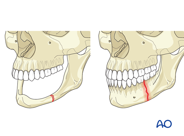 Edentulous atrophic fractures and infected fractures