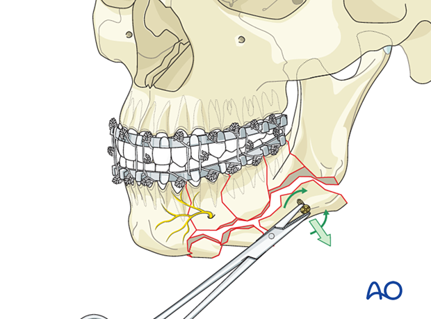 Monocortical screws can be inserted into larger bone pieces and clamped with a heavy forceps to be used as joysticks. 