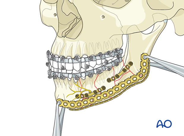 Temporary fixation of the plate to the mandible