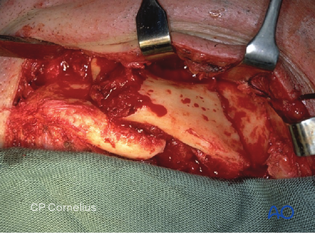 submandibular approach was used to expose a displaced complex fracture of the mandibular body