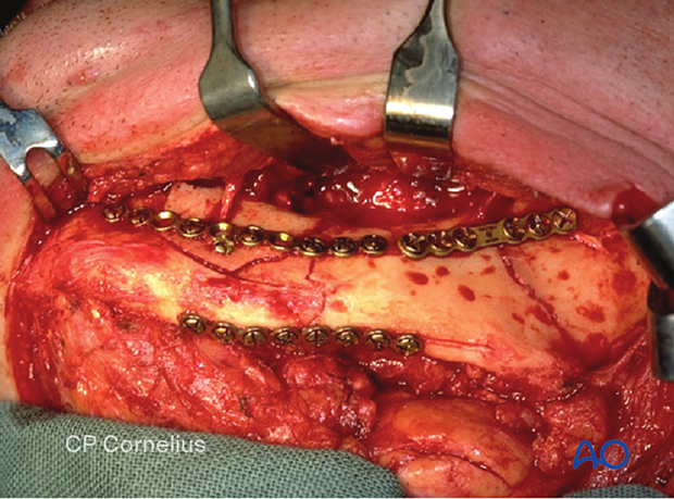 Realignment of all fragments and simplification of the fracture using miniplates on the superior border and the basal border. 