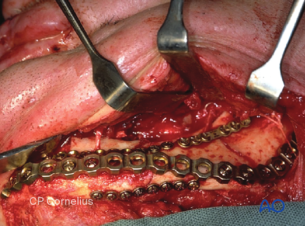 Screw fixation of the reconstruction plate with several screws (at least three) on either side of the comminuted area