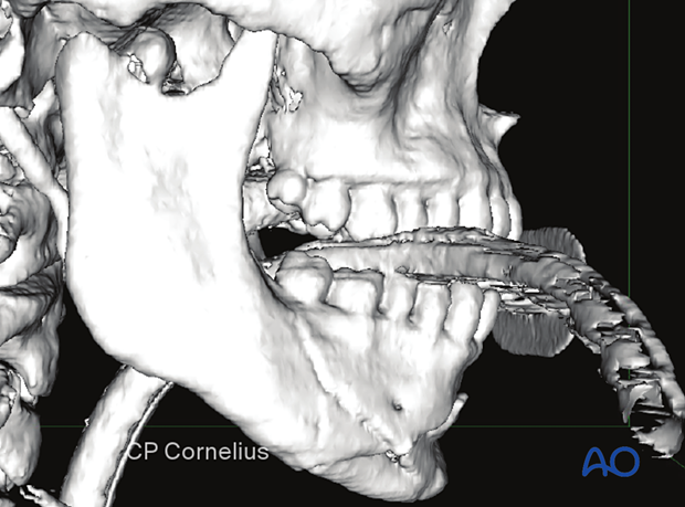 Lateral 3-D CT view.