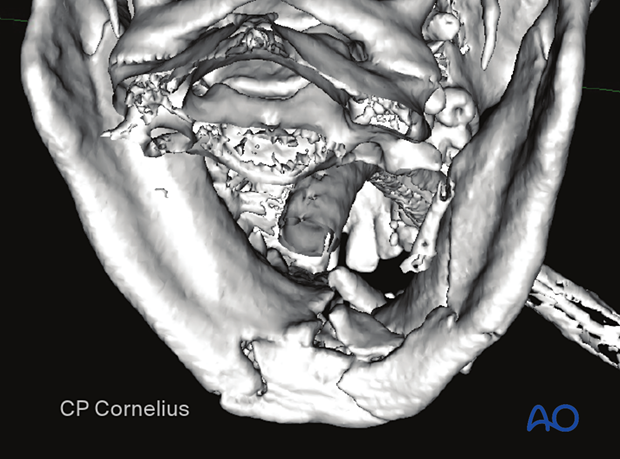 The posterior 3-D CT view 