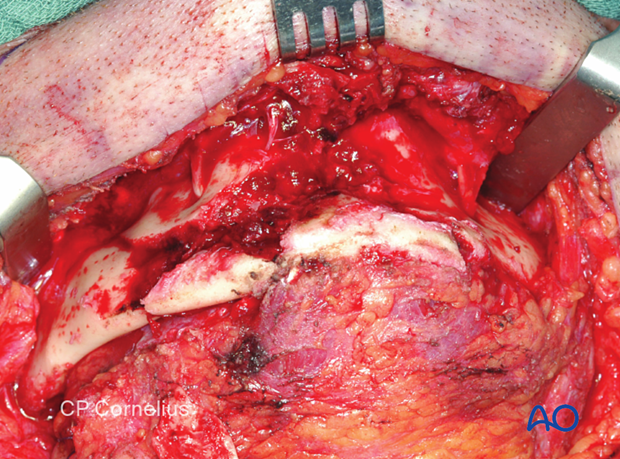 The fracture site was exposed using bilateral submandibular incisions combined with a submental incision 