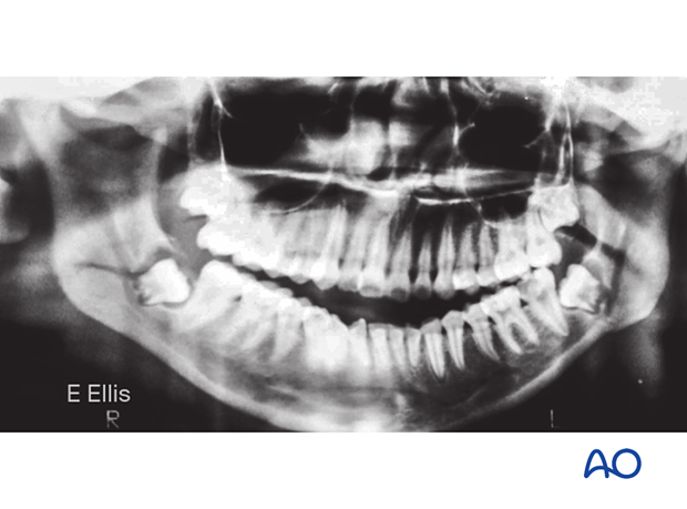 The panoramic radiograph show bilateral minimally displaced closed fractures through the mandibular angles.