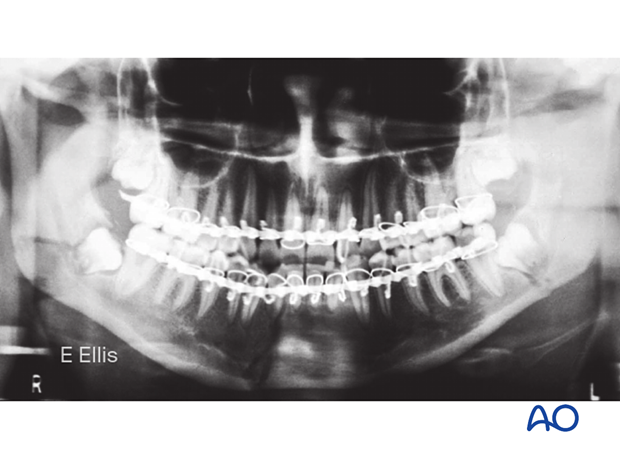 "Postoperative" panoramic radiograph following closed reduction and MMF show the good alignment of bone fragments. 