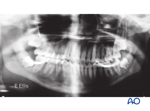 The panoramic radiograph shows restoration of the normal occlusion and satisfactory healing of fractures.