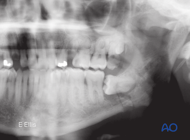 Panoramic and PA x-rays show a left simple angle fracture associated with an impacted third molar. 