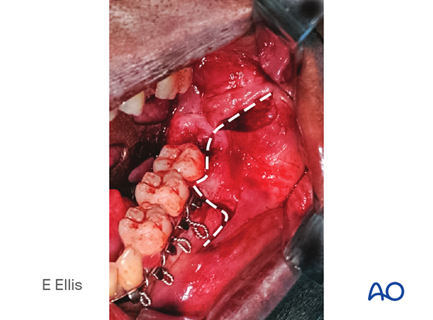 Because it is anticipated that the second molar might be removed in addition to the third molar, the soft-tissue incision is made as demonstrated.