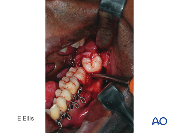 The impacted third molar is being removed because it interfered with fracture reduction.