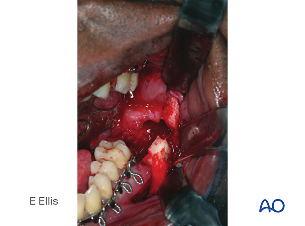 The second molar is also removed because there is a large bony defect along the posterior root.