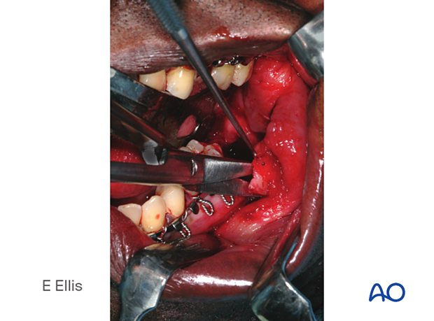 The flap is undermined with scissors to facilitate closure over the second molar extraction site.
