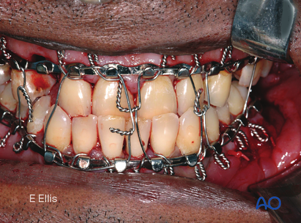 MMF is secured and left in position for 5–6 weeks. Note this patient’s preexisting malocclusion.