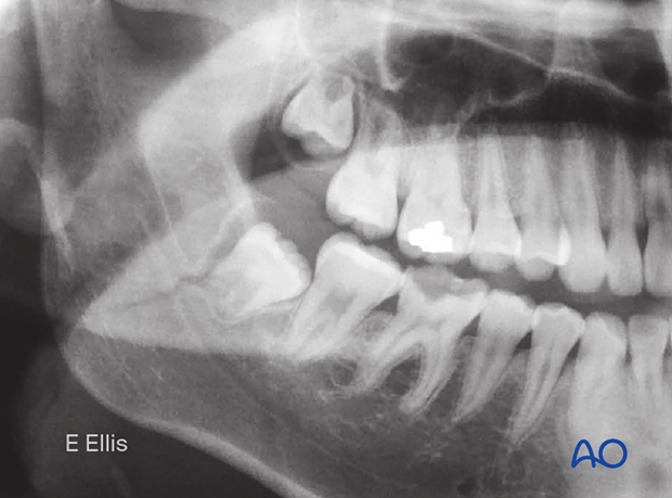 The x-rays show nondisplaced, incomplete, closed fracture through the mandibular angle.