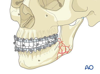 Closed treatment, MMF for Angle - complex