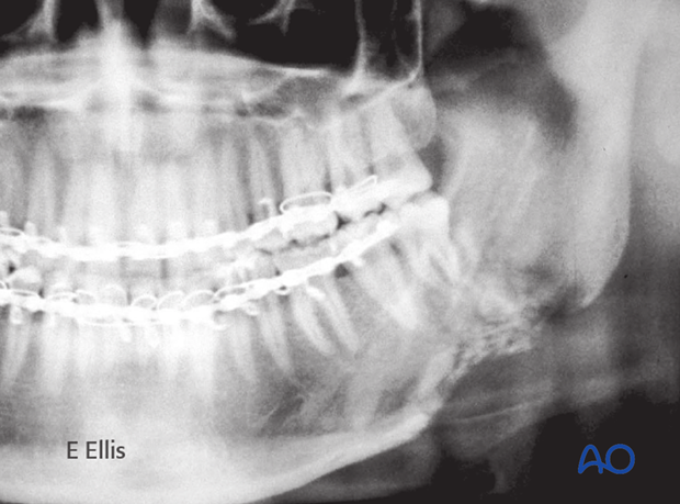 X-ray of healed angle