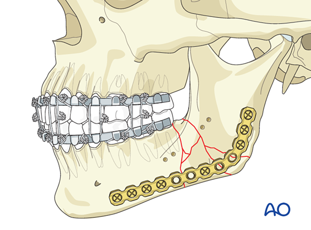Load bearing plate applied to the lower mandibular border