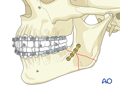 ORIF, two load sharing plates for Angle - complex