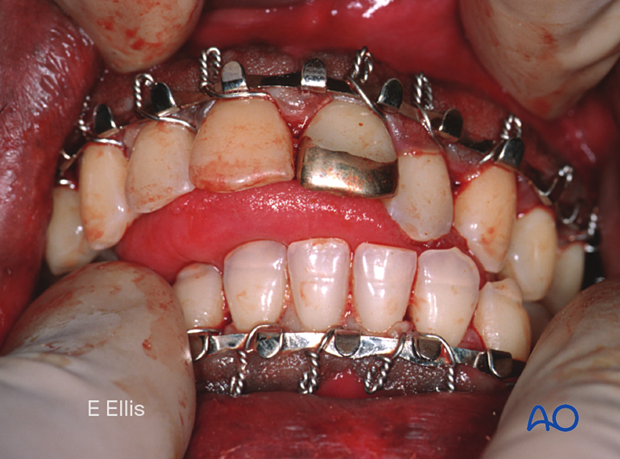 Photograph taken after placement of arch bars shows the mandible shifts left and posteriorly due to loss of condylar support.