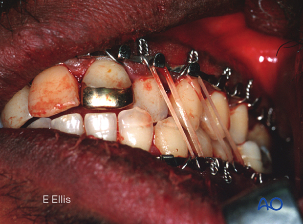 Two light elastics were all that was necessary to provide anterior support of the left mandible so that the patient could bite into normal occlusion
