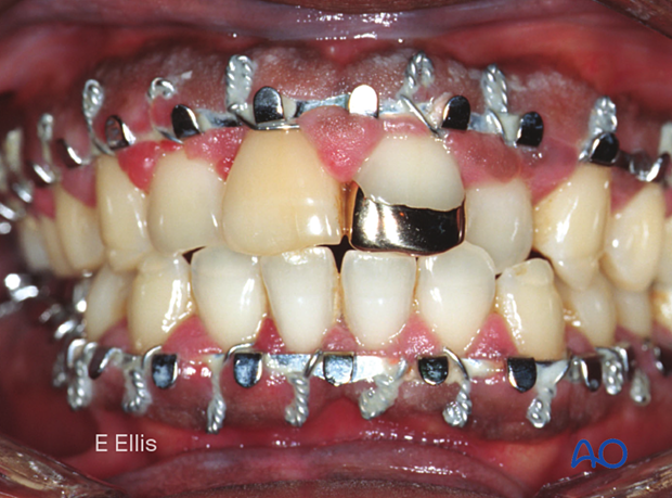 This photograph taken 6 weeks after implementation of the elastics and shows restoration of the normal occlusal relationship.