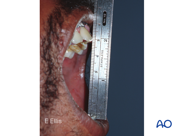 This photograph demonstrates that the patient was functionally rehabilitated to a wide interincisal opening.